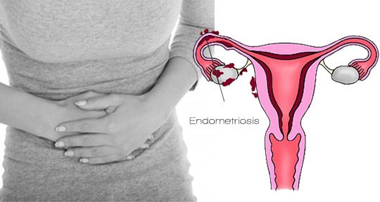 endometriosis-sintomas